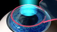 LASER EXIMERE 2