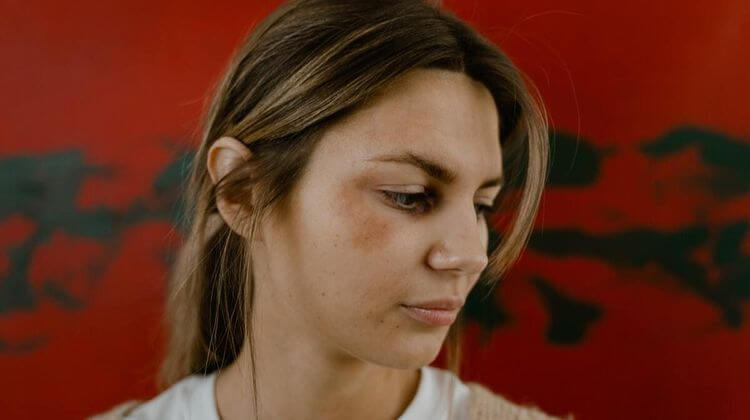 Une femme avec un bleu à l'oeil.