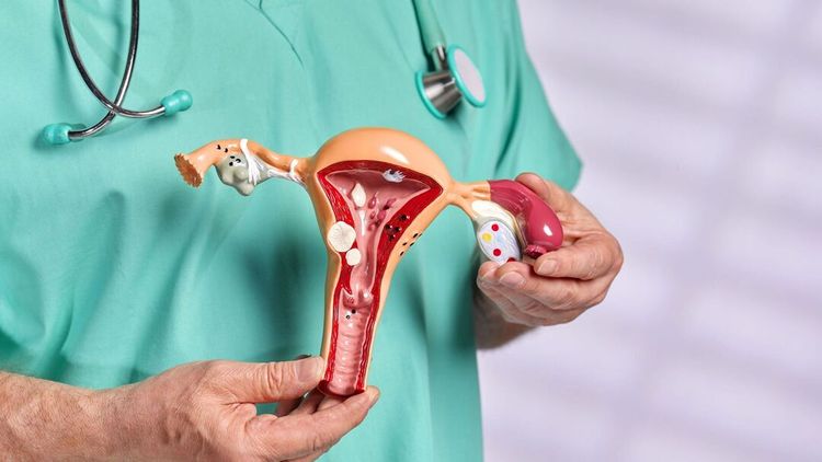Un médecin tient la représentation d'un vagin atteint d'endométriose.